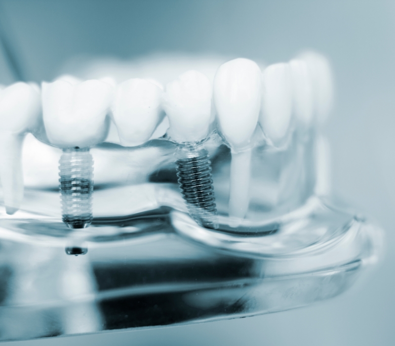 インプラントとは