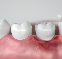 歯周病とインプラントの関係性