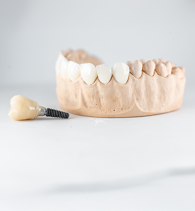 インプラント体の埋入