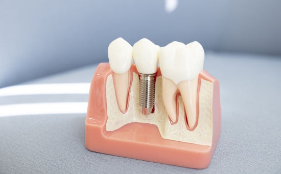 インプラントを長く使うためのサポート体制