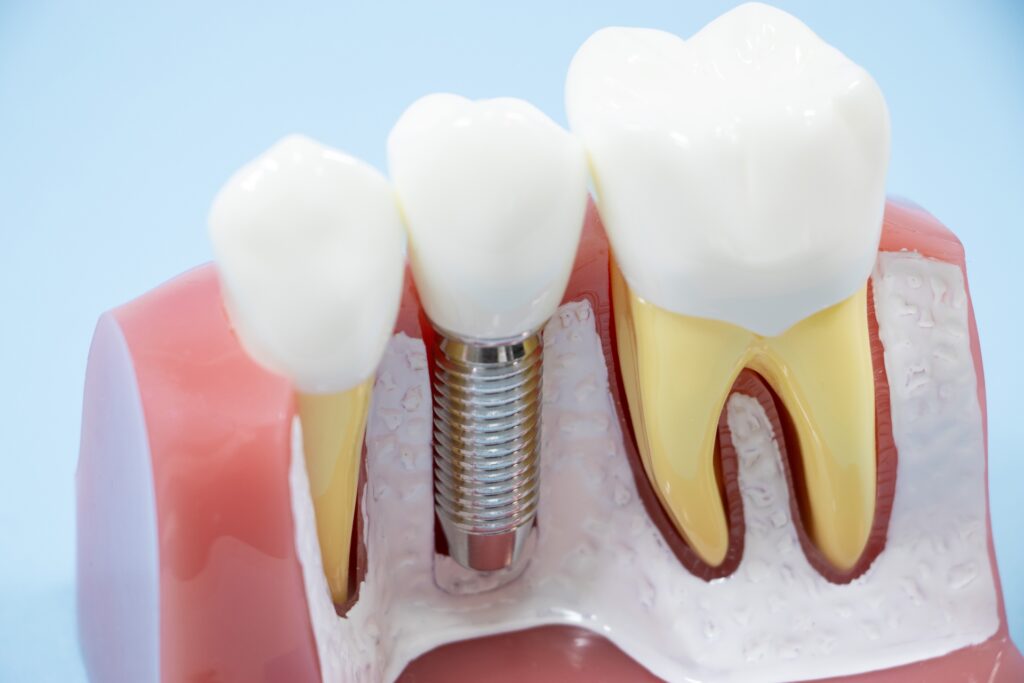 インプラントとは